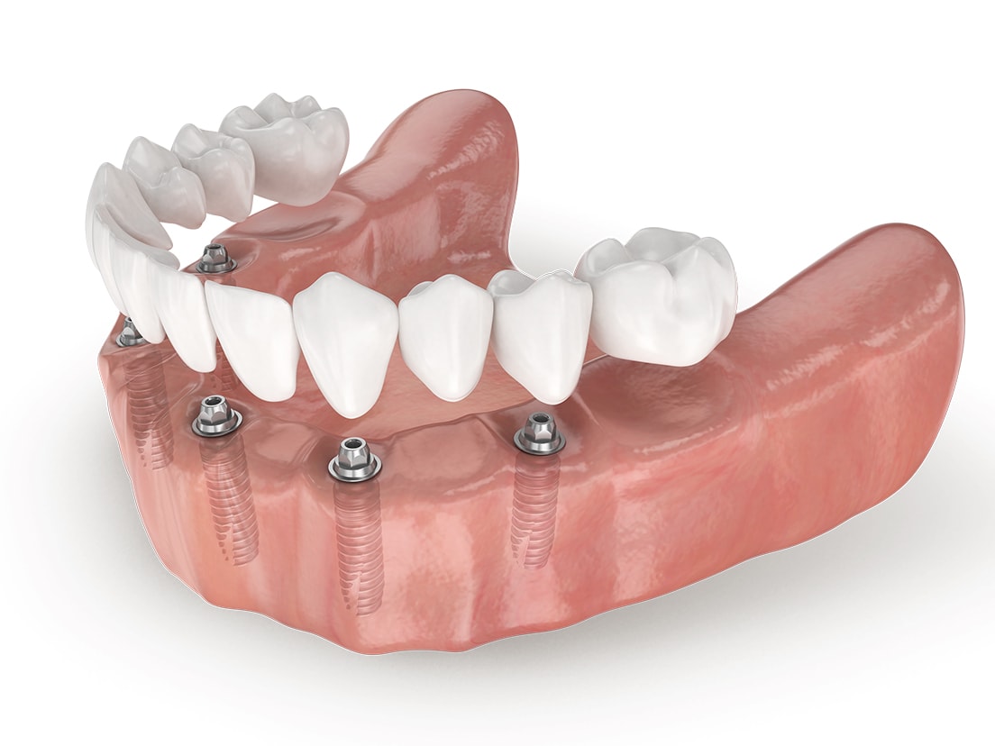 протезирование зубов мосты